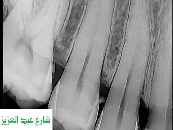 سينسور أشعة الأسنان - سعر لا يقاوم! (5 فقط متوفرة)