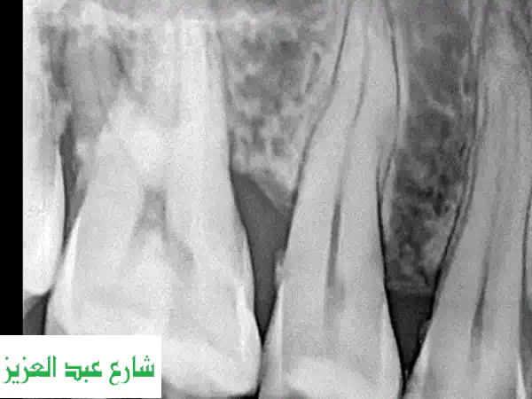 سينسور أشعة الأسنان - سعر لا يقاوم! (5 فقط متوفرة)