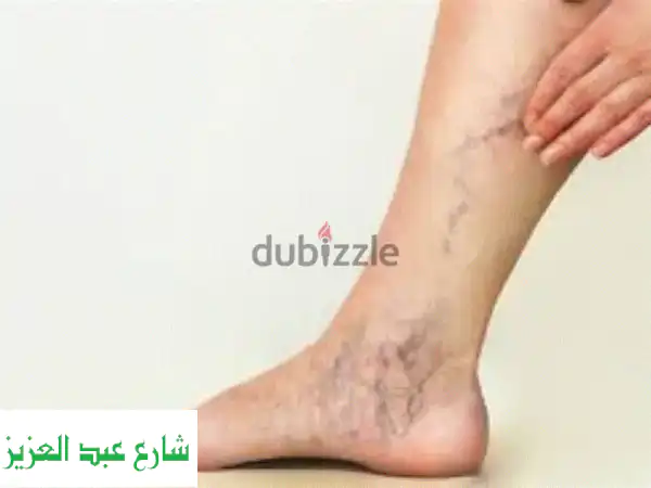 ودّعي الدوالي للأبد! جلسة واحدة فقط لعلاج الدوالي...