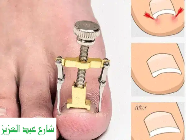 قل وداعًا للأظافر الغائرة! حل سهل وآمن مع جهازنا الجديد