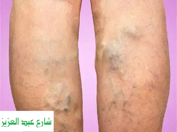 فحص وعلاج الأوعية الدموية بدون جراحة | مركز...